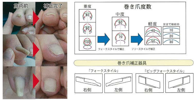 ペディグラス　フォークスタイル巻き爪補正