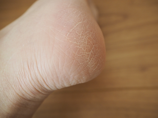 踵のひび割れ　踵はガサガサしていませんか？