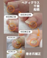 巻き爪補正ベーシックコース – 巻き爪ケア・ヨネクラ｜千葉市