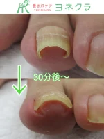 巻き爪補正ベーシックコース – 巻き爪ケア・ヨネクラ｜千葉市