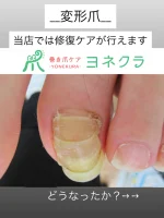 巻き爪補正ベーシックコース – 巻き爪ケア・ヨネクラ｜千葉市稲毛区
